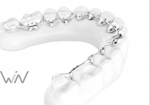 Win Braces